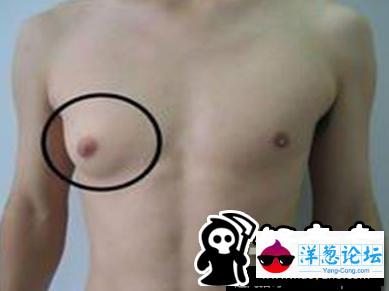 男子胸部肿胀挤出“乳汁” 医生惊呆：第一次见(4)