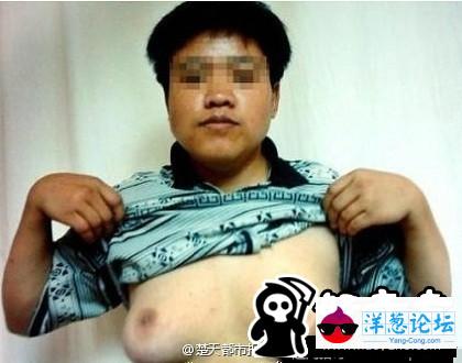 男子胸部肿胀挤出“乳汁” 医生惊呆：第一次见(1)